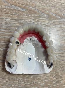 Buy cheap Cement Teeth Implant Dental Bridge PFM Screwed Metal Porcelain product