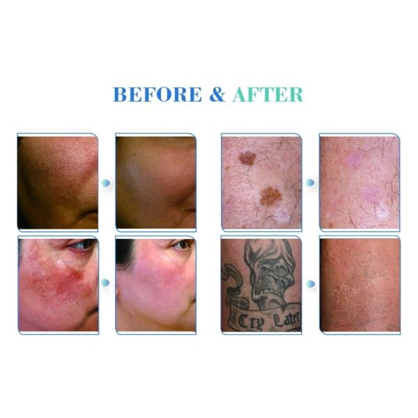 Professional picosecond picosure laser tattoo removal machine with Medical CE certification quick tattoo removal