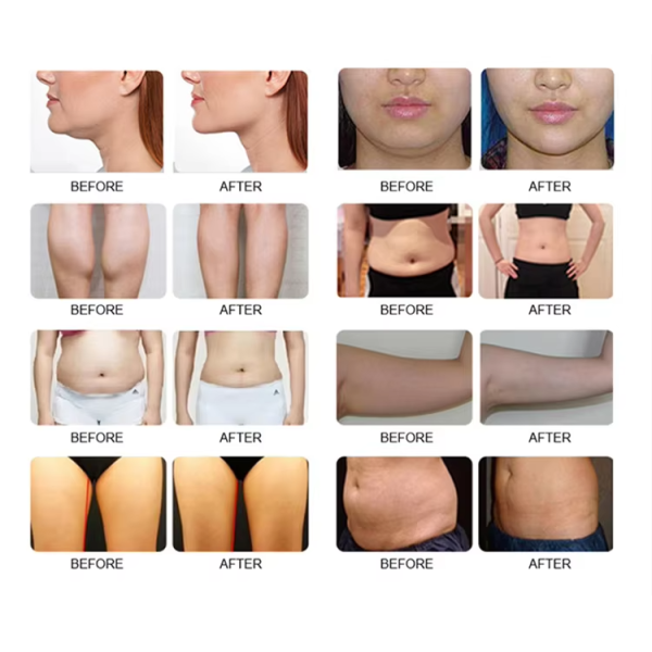 Dual Handle Chin And Body Shaping Cooling Pads Cryolipolysis Machine
