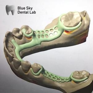 Buy cheap Removable Partial Denture Metal Framework Partial Denture Framework Design product