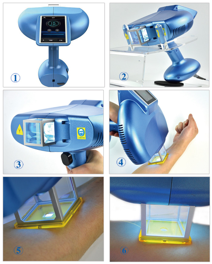 XeCI Lamp Excimer Laser Technology Vitiligo Machine 16cm2 Spot 308nm