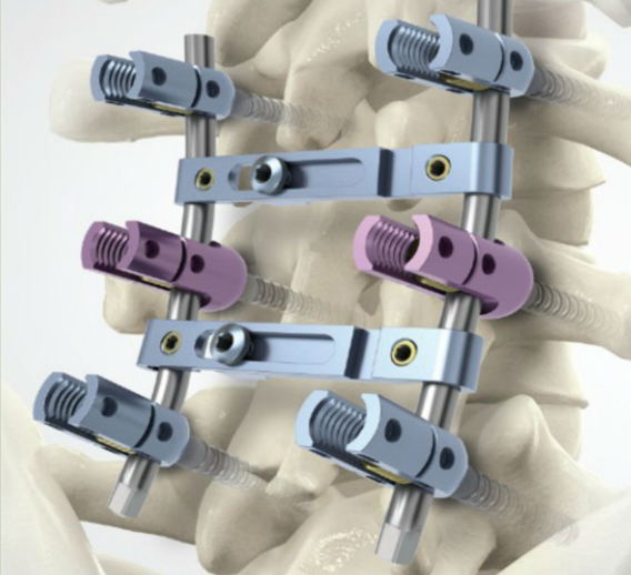 Multi Axial U Shaped Screw , Orthopedic Pedicle Screws Spine Titanium Material