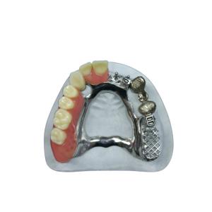 China Beautiful Appearance Precision Attachment Denture Implant Attachments on sale