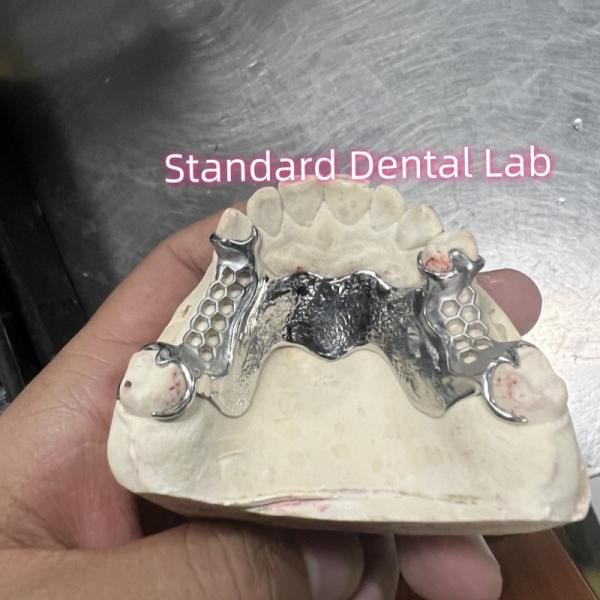 Quality Cobalt Chrome Cast Frame Partial Denture Vitallium 2000 for sale