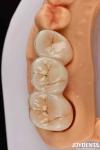 Experience Color Realistic Full Zirconia With High Resistance To Staining And