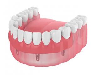 Buy cheap Dentures Missing Teeth Dental Implant Bar Fillings Dentures Temporary Removable Dentures product