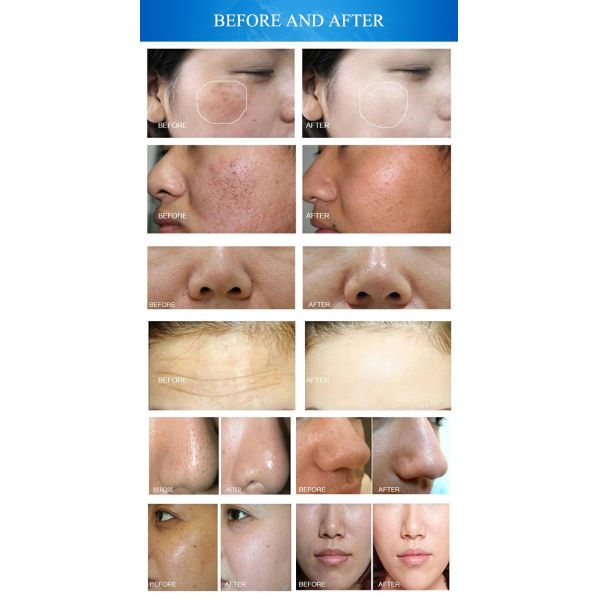 Microdermabrasion Beauty 10 In 1 Hydrafacial Machine Skin Peel Device