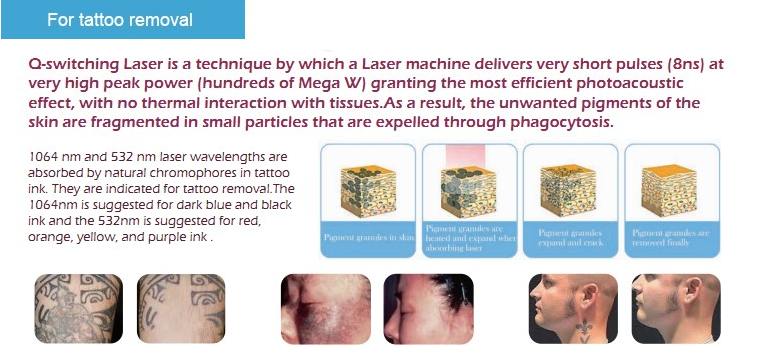 755, 650 1064nm q switched yag laser for hyperpigmentation nd yag laser system