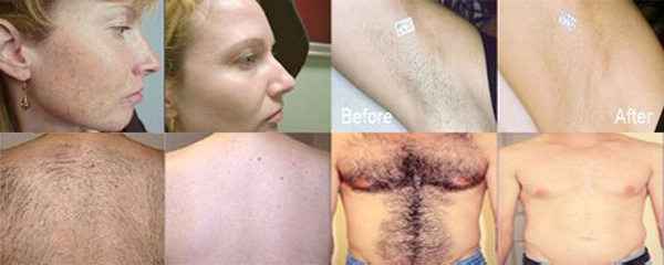 Fast Intense pulsed light professional best ipl photo rejuvenation machine for beauty center use