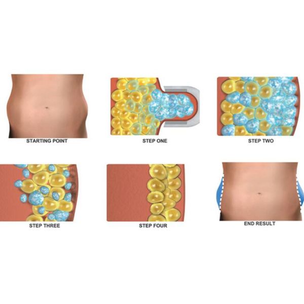 cryolipolysis slimming machine fat freeze machine 2016