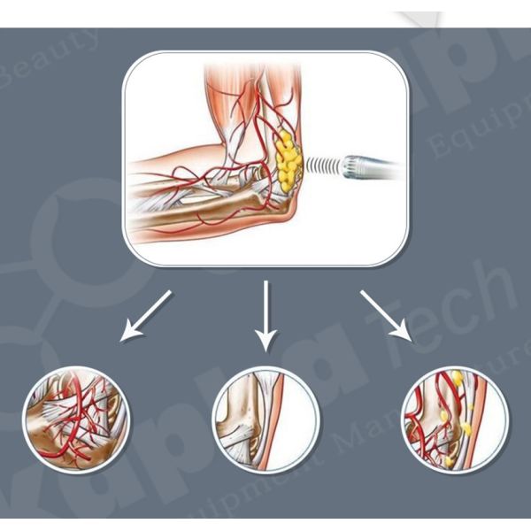 COOL WAVE Cryotherapy Slimming Machine /Fat Freezing Cryolipolyse Equipment With Shockwave Cellulite Removal