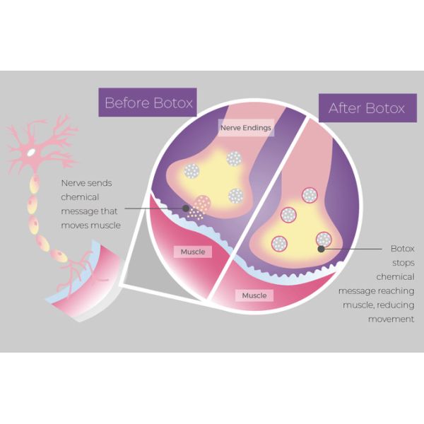 Reducing Skin Wrinkles Botulinum Toxin Type A 100 Units