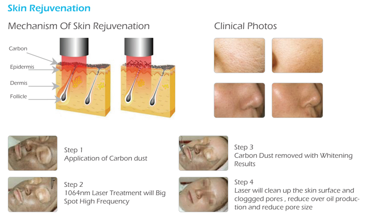 Toppest 755 650 585 Optional Hot Sales Laser Picosecond Tattoo Removal Machine